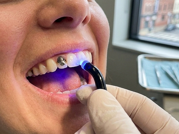 Are Tooth-Colored Fillings in Nashville Better for Visible Teeth?