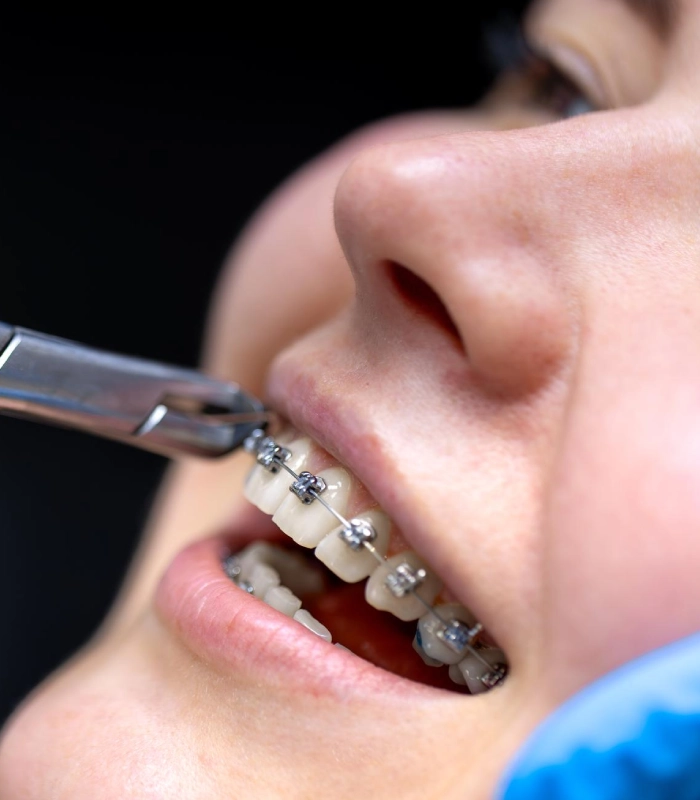 Implant Dentures, Implant Bridges