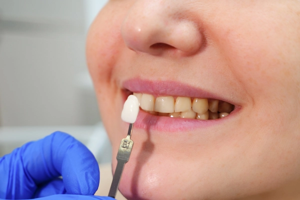 Crowns & Veneers in Nashville